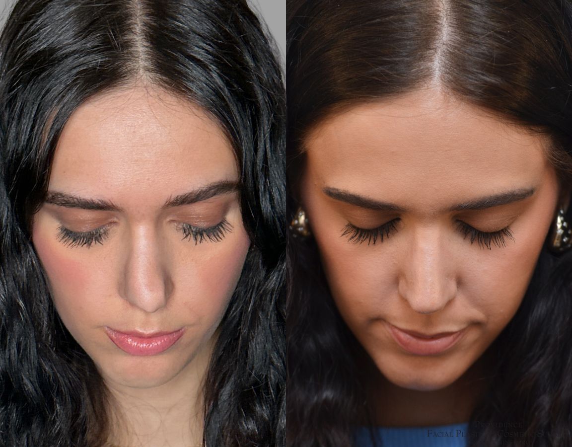 Before and after Revision Rhinoplasty case 43678 - Angle 6