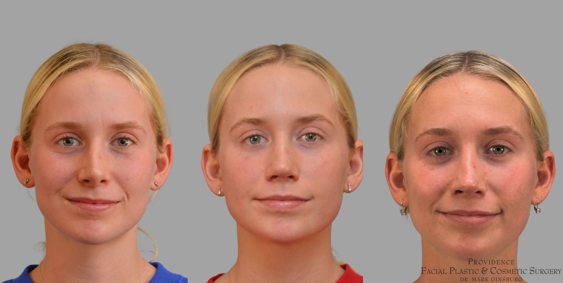 Before and after Revision Rhinoplasty case 41761 - Angle 3