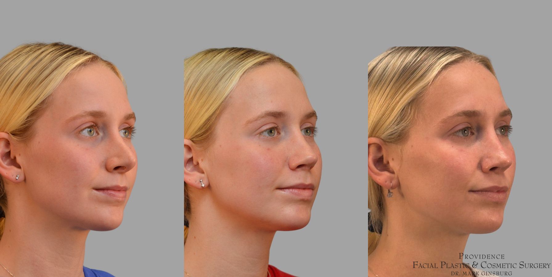 Before and after Revision Rhinoplasty case 41761 - Angle 4