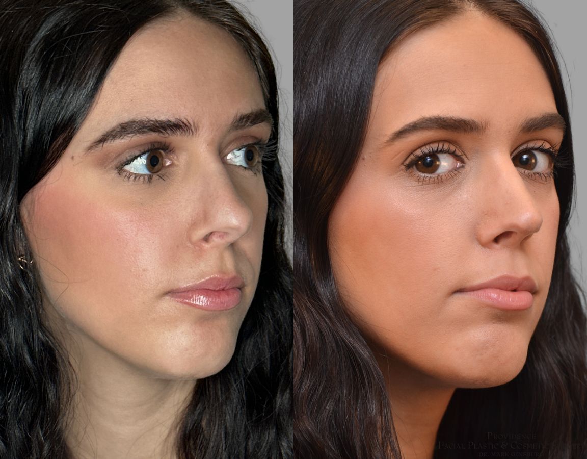 Before and after Revision Rhinoplasty case 43678 - Angle 4