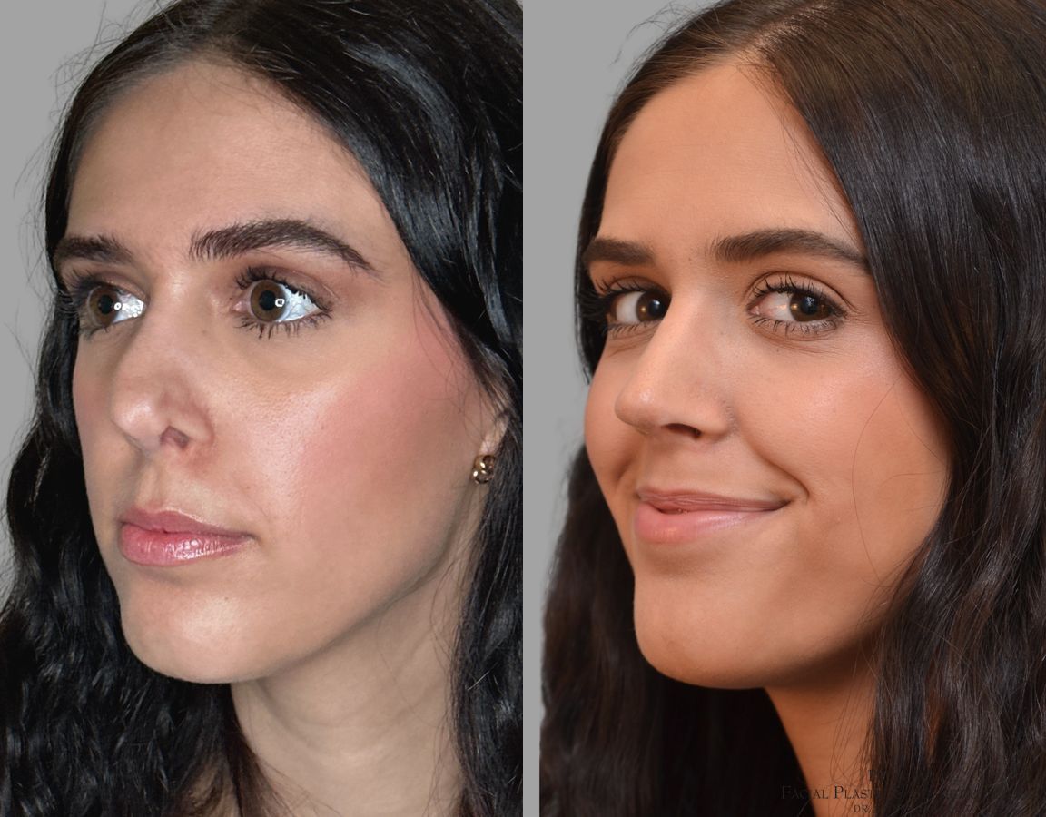 Before and after Revision Rhinoplasty case 43678 - Angle 2