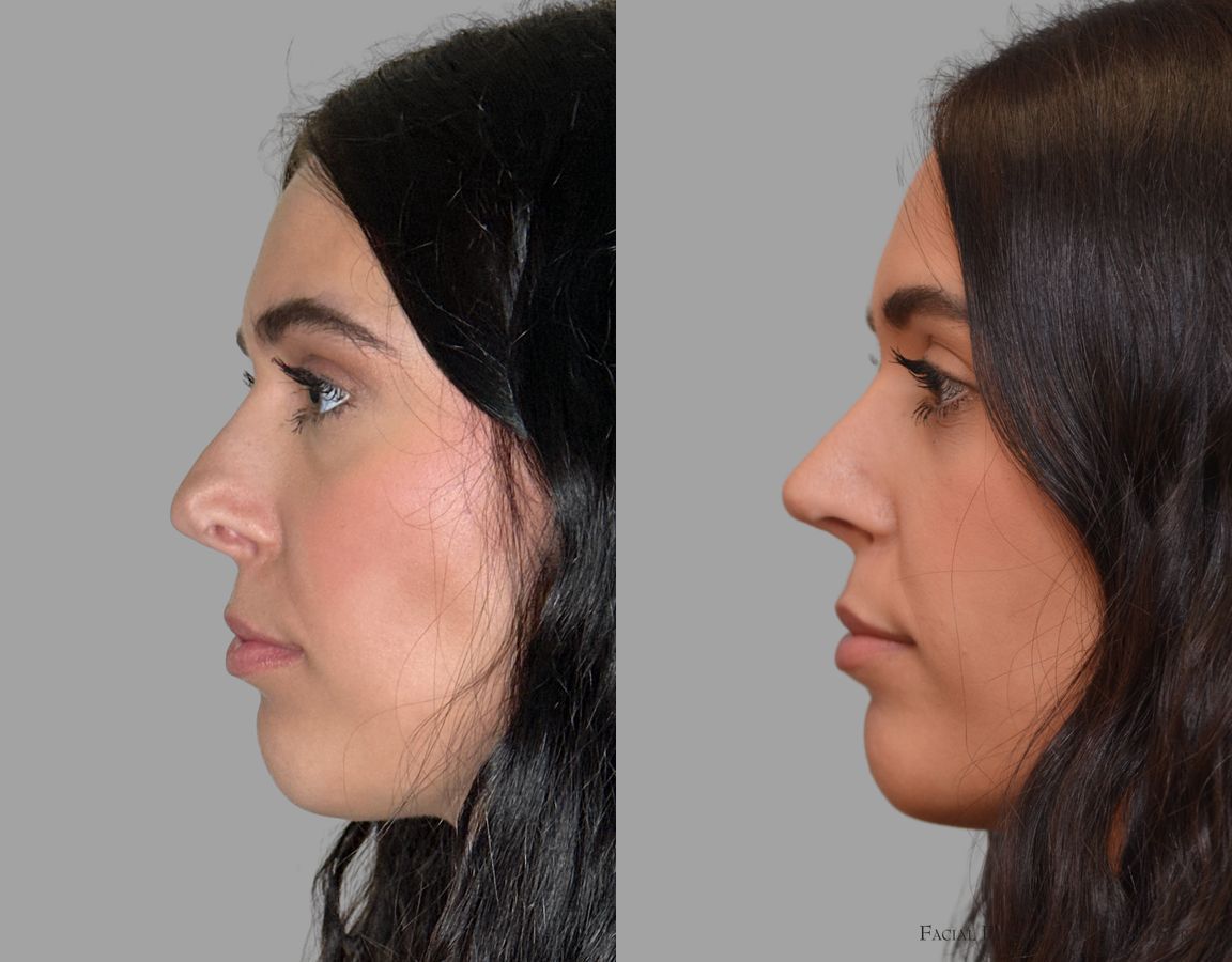 Before and after Revision Rhinoplasty case 43678