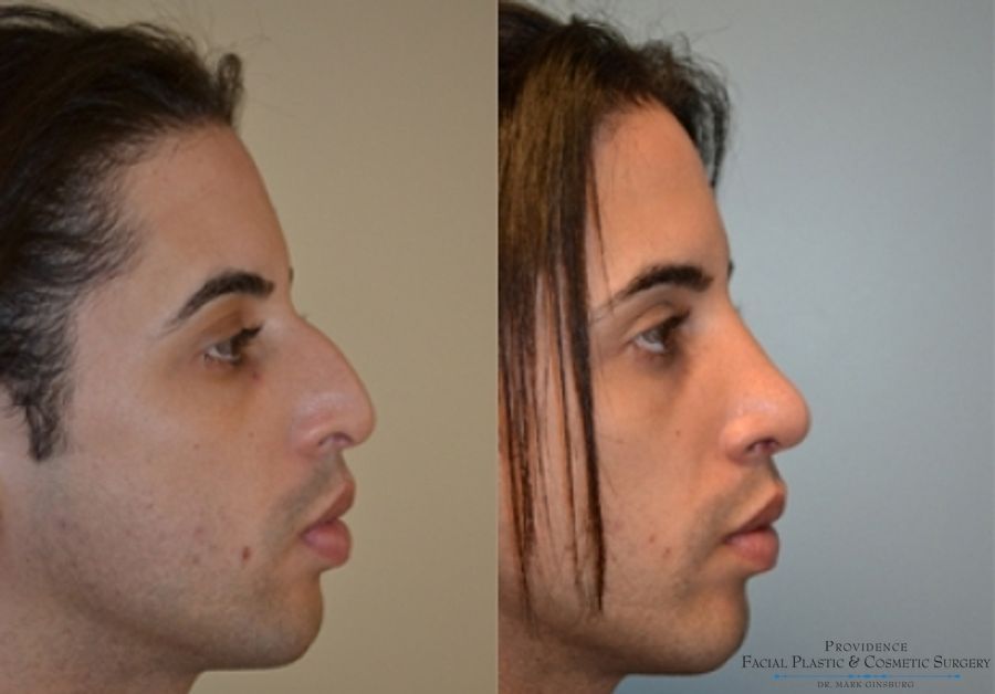 Before and after Primary Rhinoplasty case 31602 - Angle 2