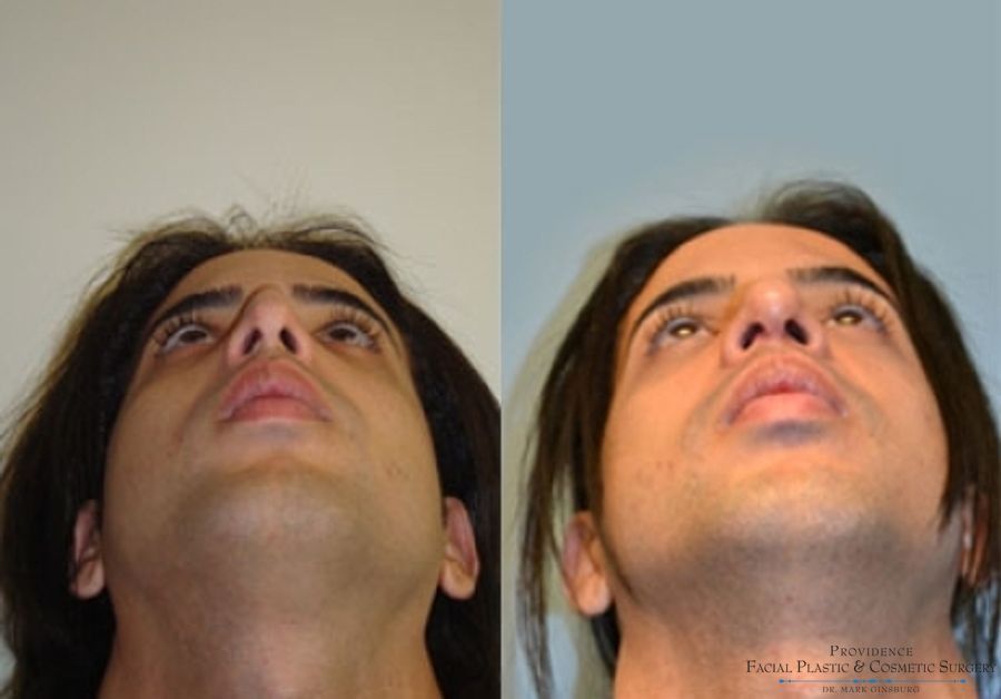 Before and after Primary Rhinoplasty case 31602 - Angle 4