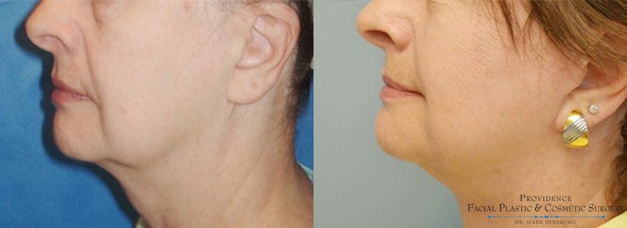 Before and after Facelift case 31648 - Angle 3
