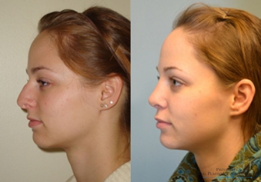 Before and after Primary Rhinoplasty case 31623 - Angle 3