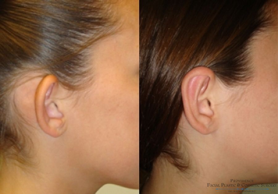 Before and after Otoplasty case 31641 - Angle 2