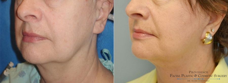 Before and after Facelift case 31648 - Angle 2