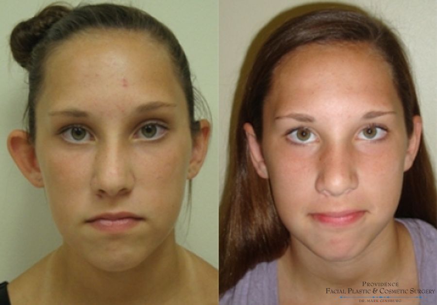 Before and after Otoplasty case 31641