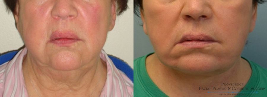 Before and after Facelift case 31645 - Angle 2