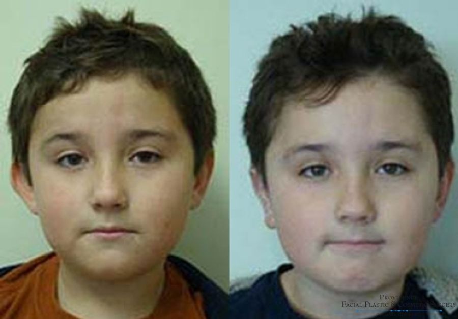 Before and after Otoplasty case 31661