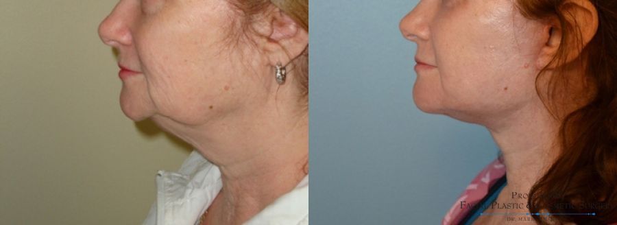 Before and after Facelift case 31650 - Angle 3