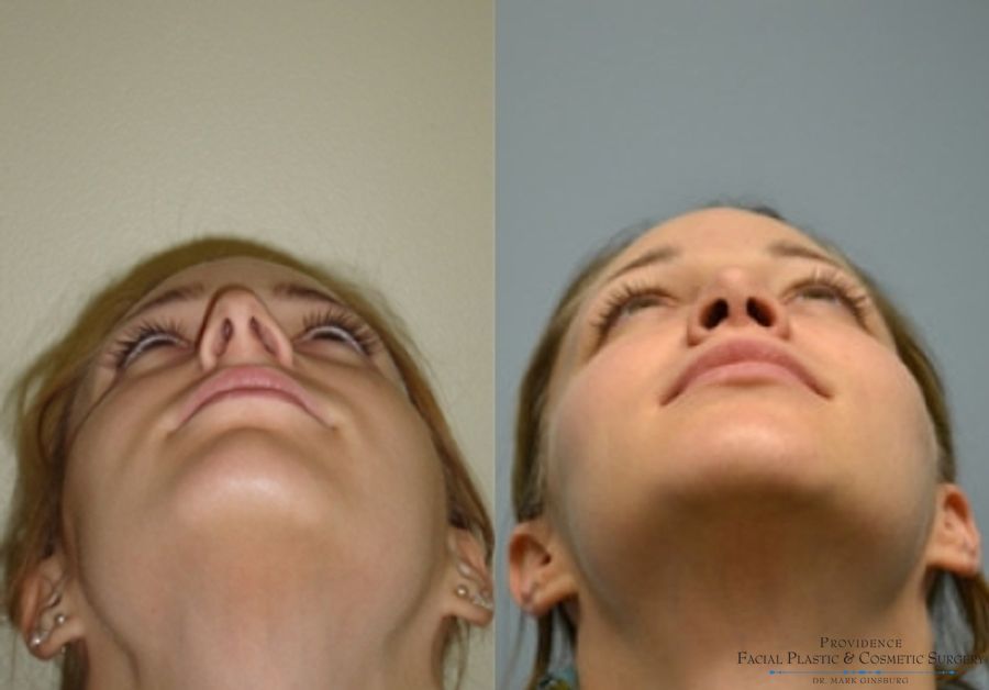 Before and after Primary Rhinoplasty case 31623 - Angle 4