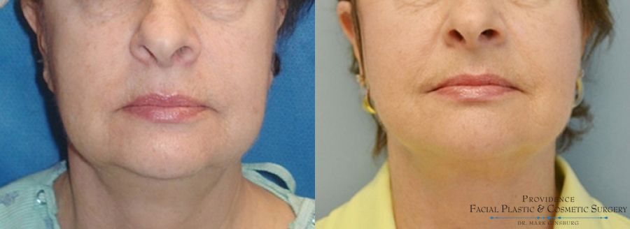 Before and after Facelift case 31648