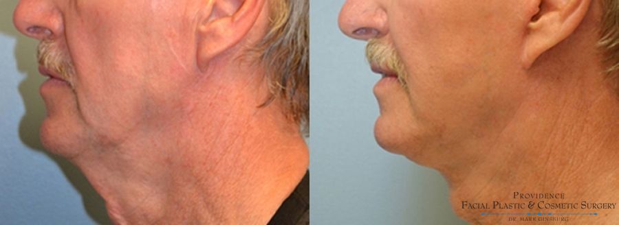 Before and after Facelift case 31649 - Angle 3