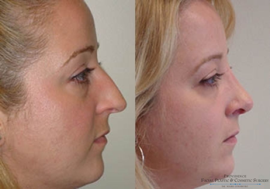 Before and after Primary Rhinoplasty case 31621 - Angle 2