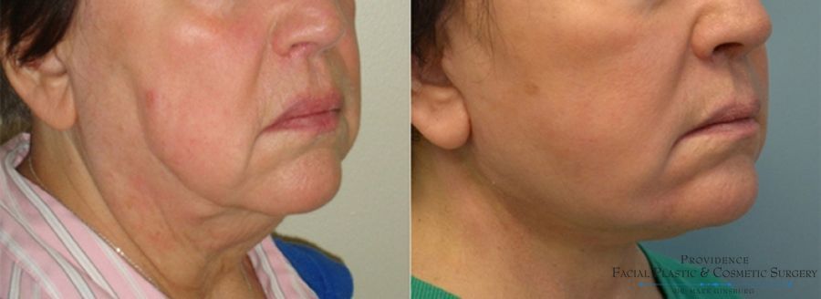 Before and after Facelift case 31645