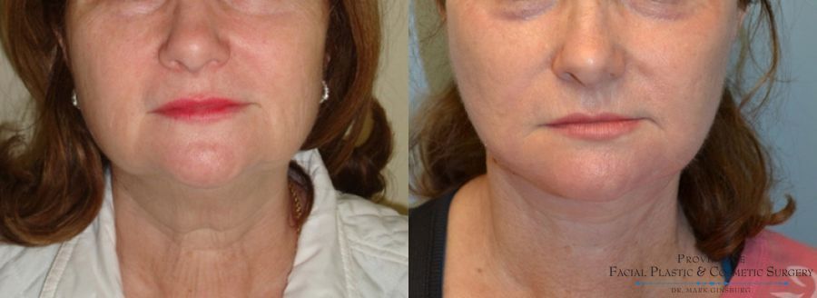 Before and after Facelift case 31650