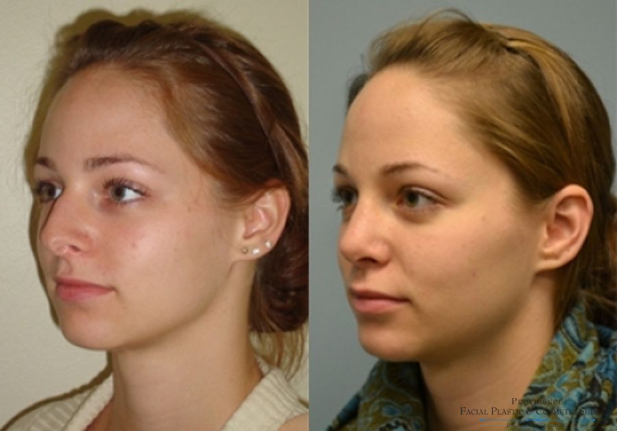 Before and after Primary Rhinoplasty case 31623 - Angle 2