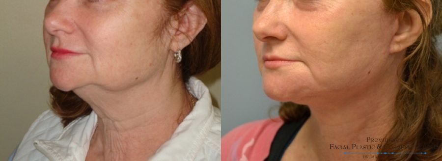 Before and after Facelift case 31650 - Angle 2