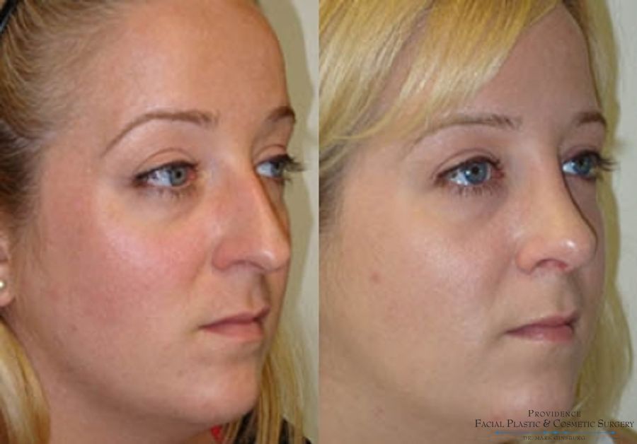 Before and after Primary Rhinoplasty case 31621