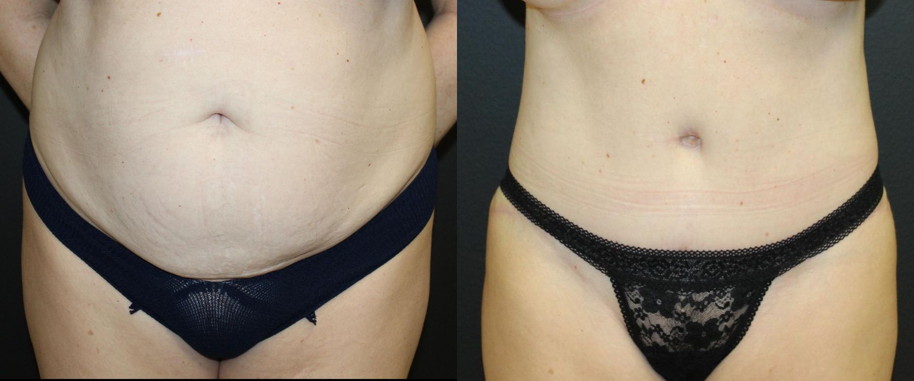 Before and after 360 Body Contour case 32595