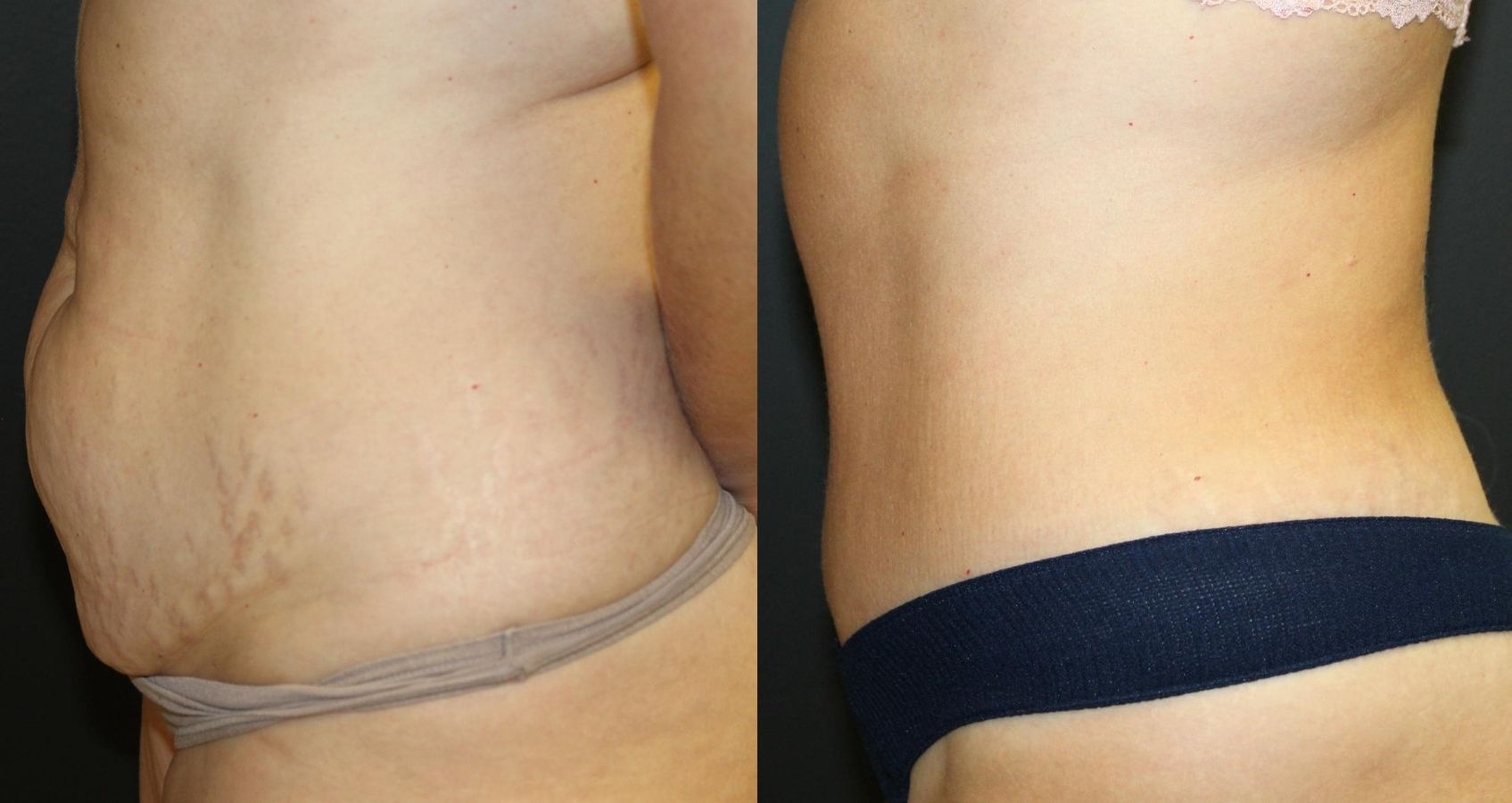 Before and after 360 Body Contour case 32594 - Angle 3