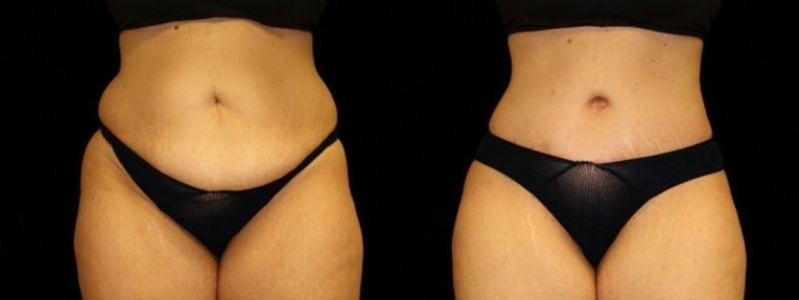 Before and after 360 Body Contour case 32606