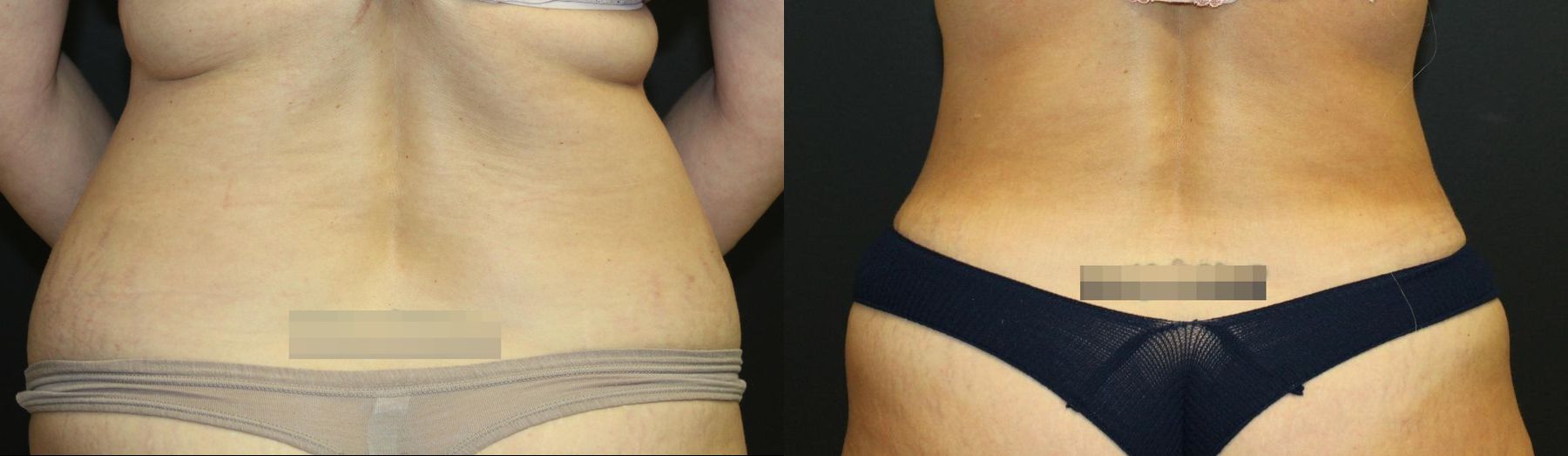 Before and after 360 Body Contour case 32594 - Angle 4