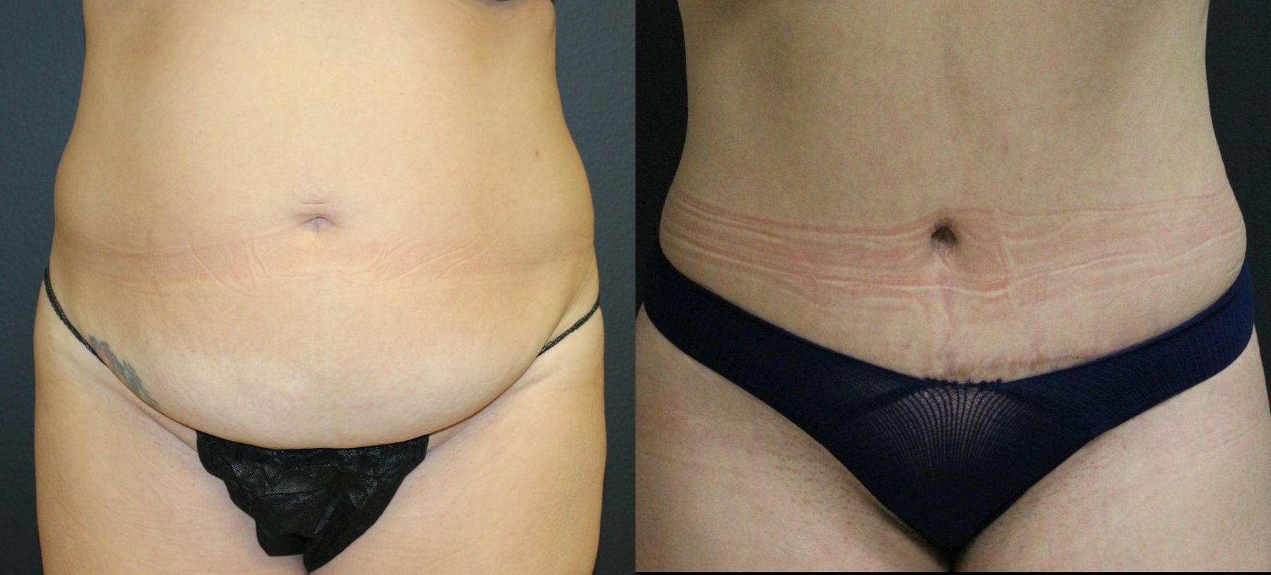 Before and after 360 Body Contour case 32593