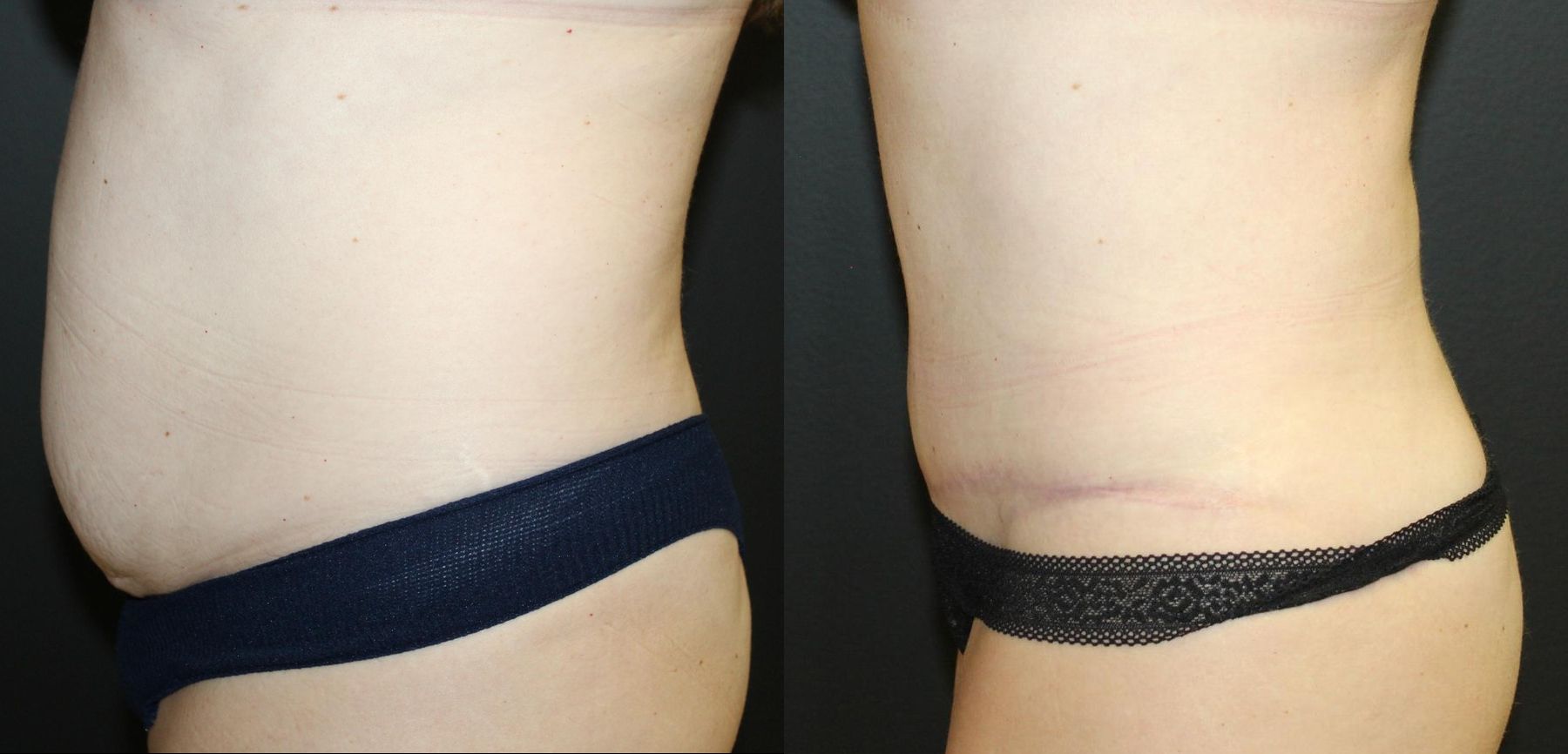 Before and after 360 Body Contour case 32595 - Angle 3