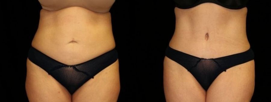 Before and after 360 Body Contour case 32629