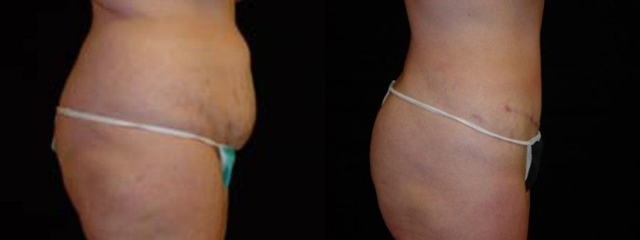 Before and after 360 Body Contour case 32597