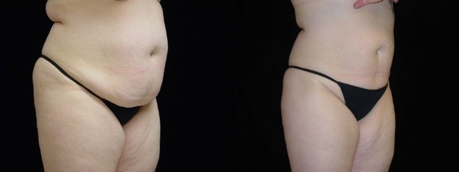 Before and after 360 Body Contour case 32598