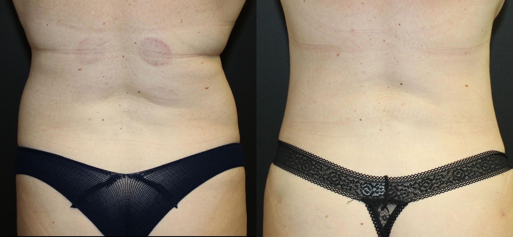 Before and after 360 Body Contour case 32595 - Angle 4