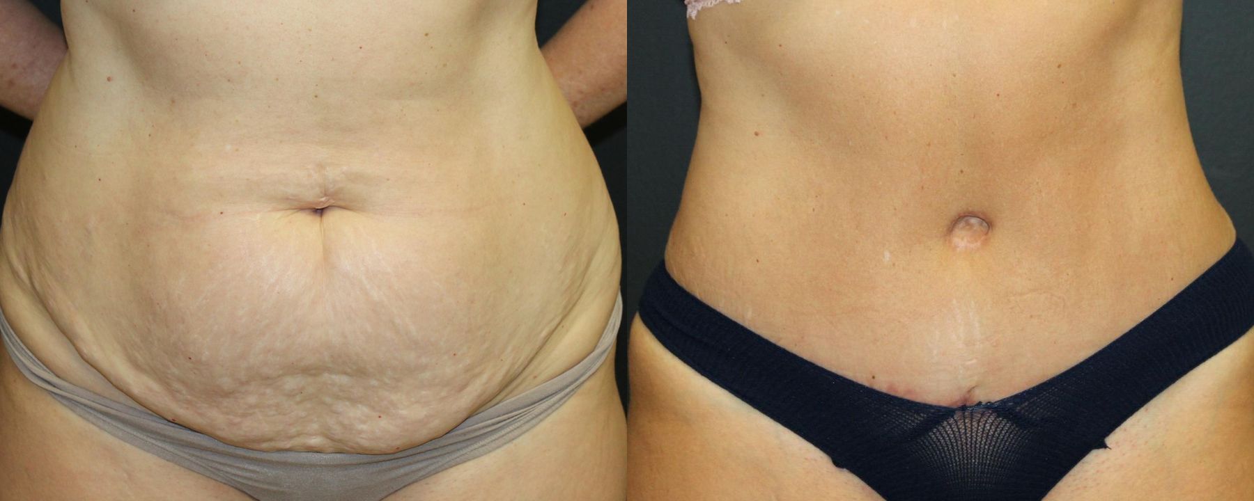 Before and after 360 Body Contour case 32594