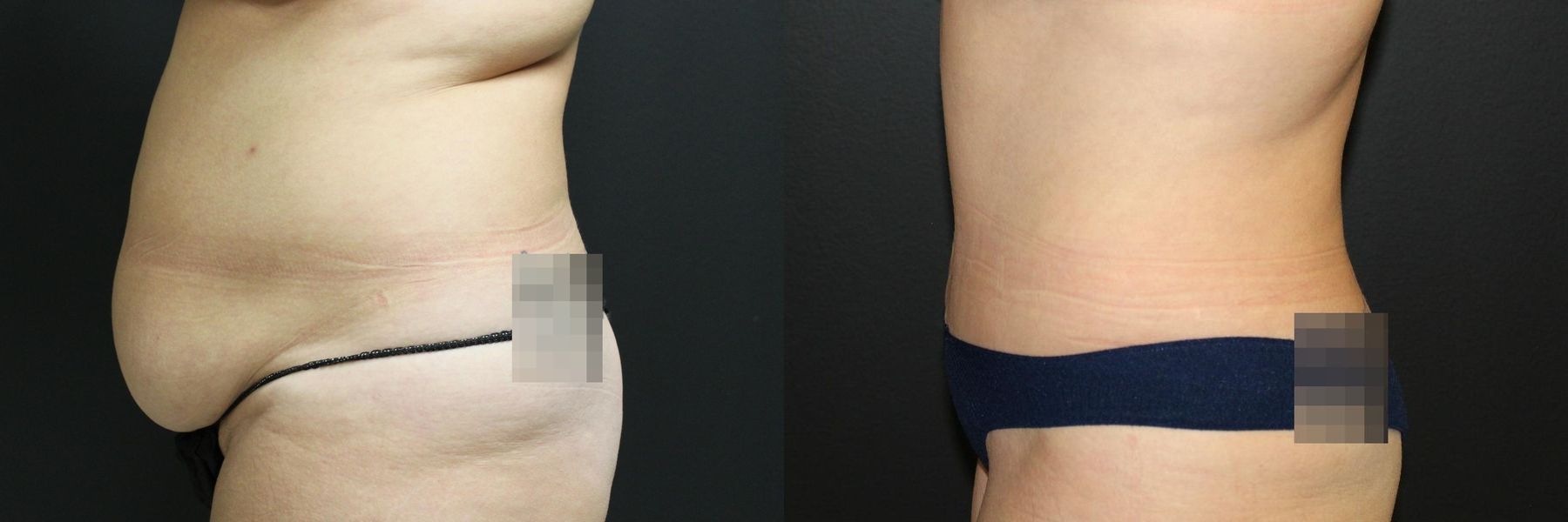 Before and after 360 Body Contour case 32593 - Angle 3