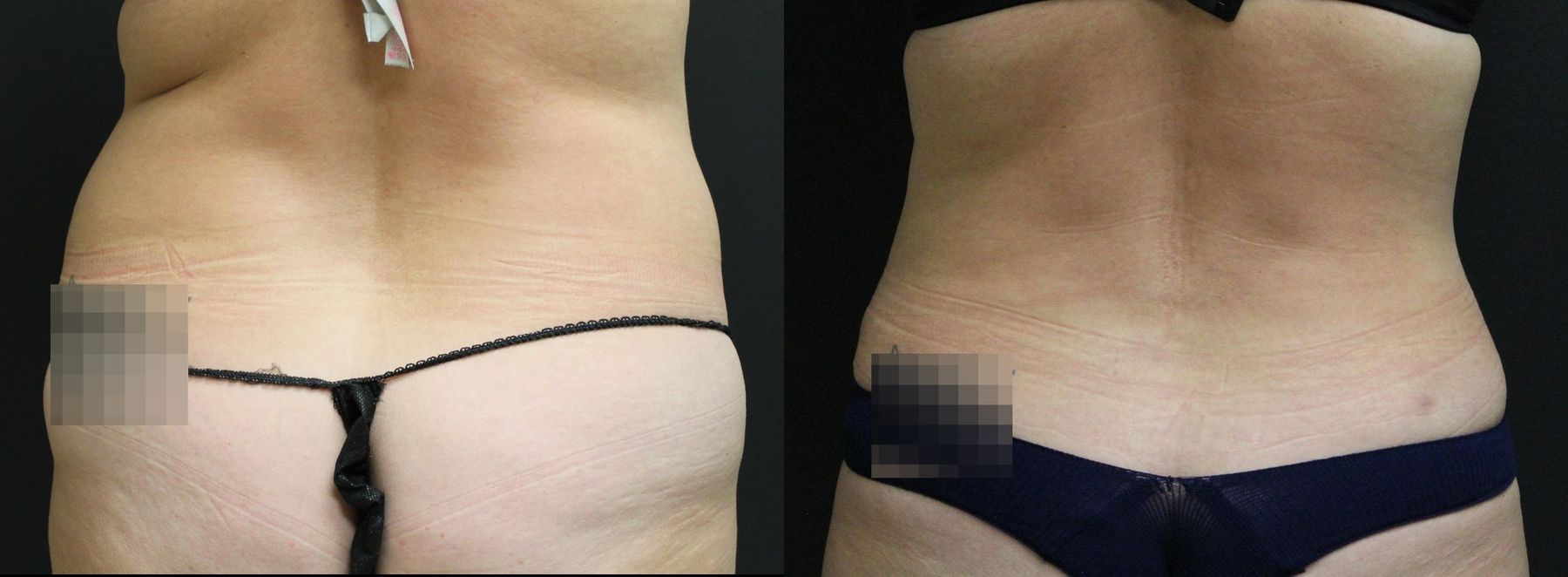 Before and after 360 Body Contour case 32593 - Angle 4