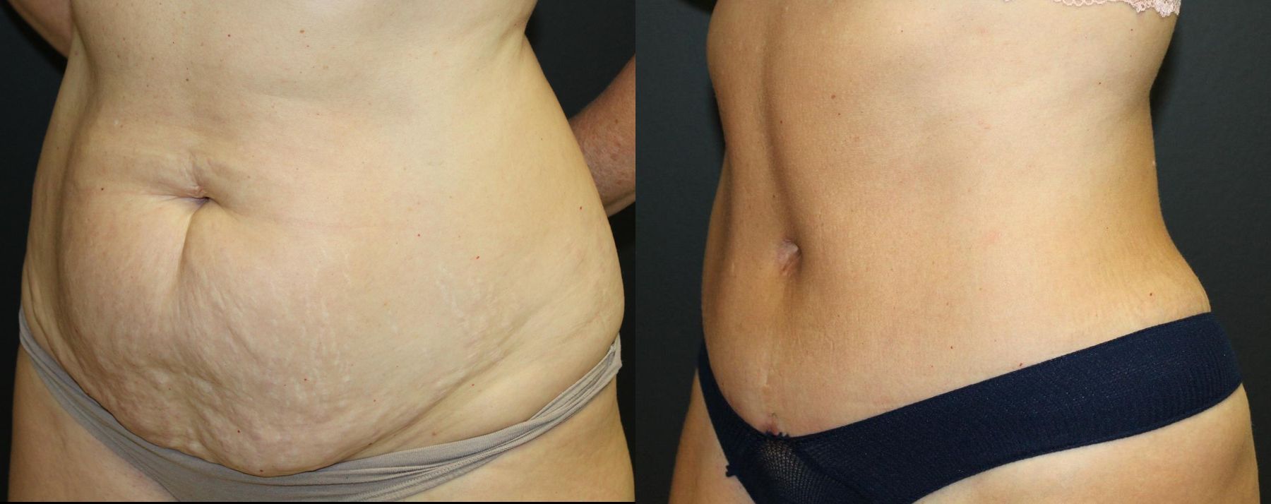 Before and after 360 Body Contour case 32594 - Angle 2