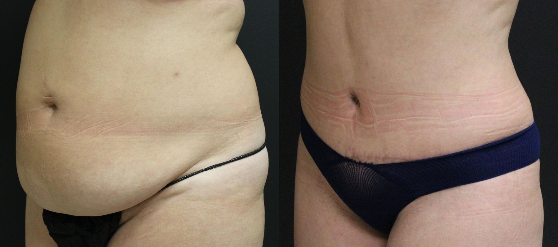 Before and after 360 Body Contour case 32593 - Angle 2