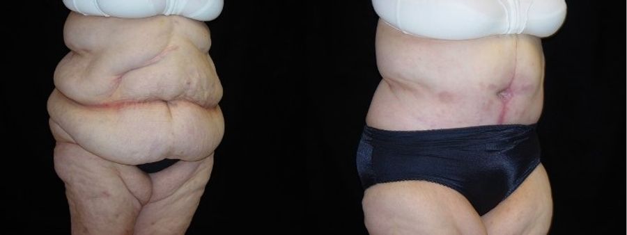 Before and after After Weight Loss case 32740