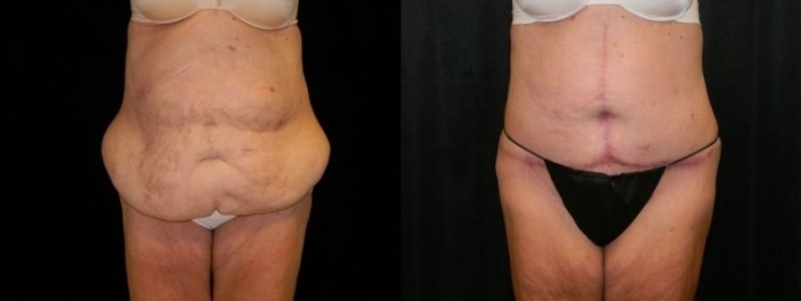 Before and after After Weight Loss case 32754
