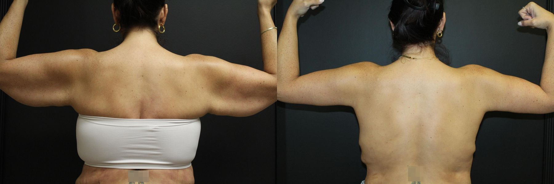Before and after Arm Lift case 32734 - Angle 2