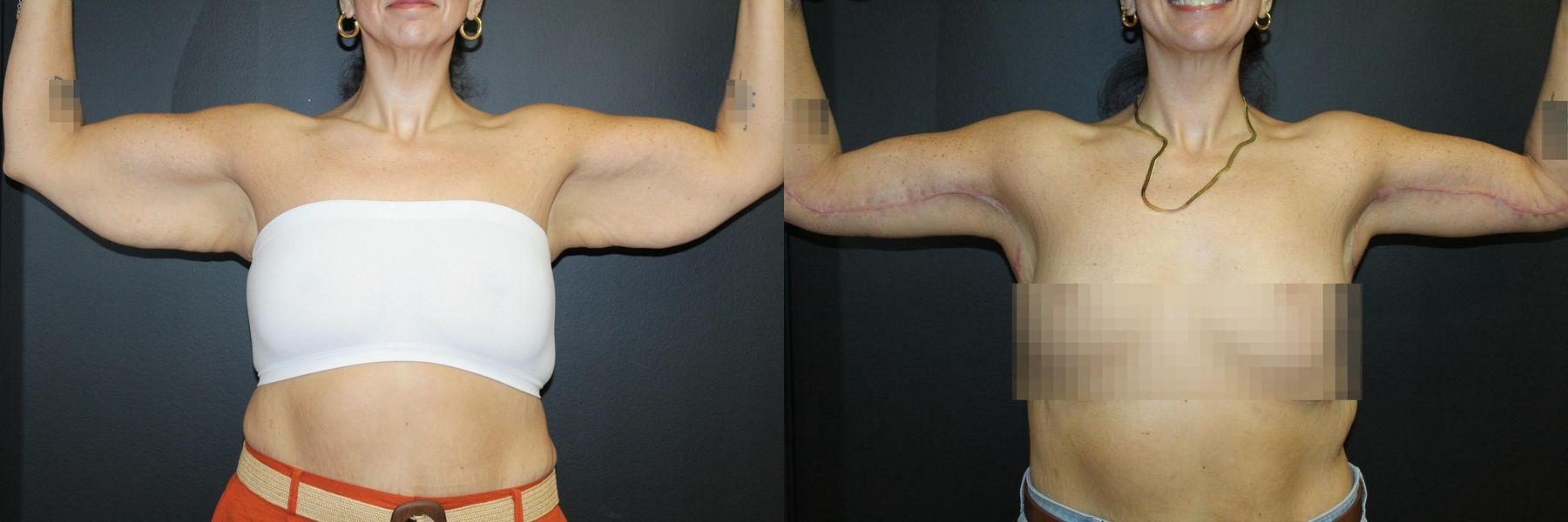 Before and after Arm Lift case 32734