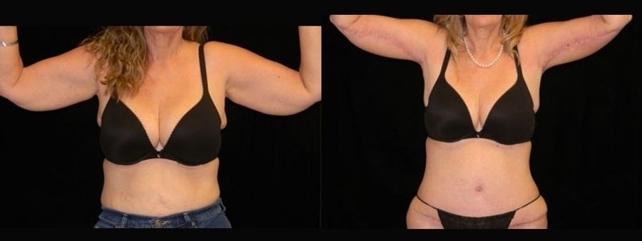 Before and after Arm Lift case 32749