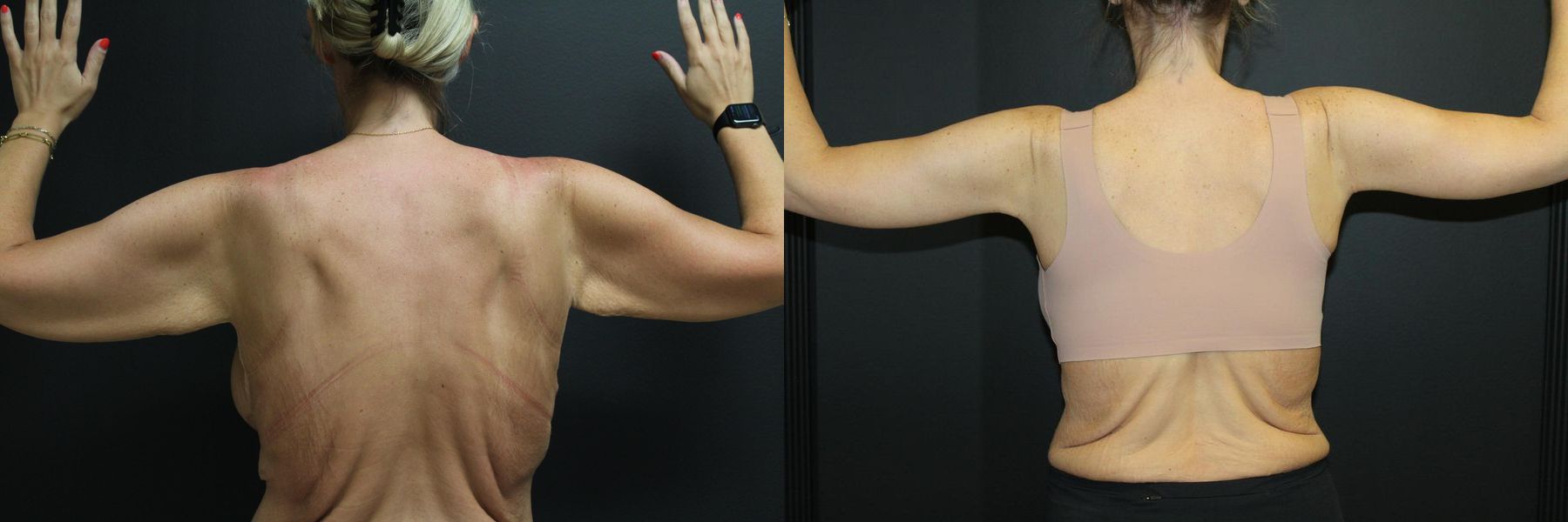 Before and after Arm Lift case 32733 - Angle 2