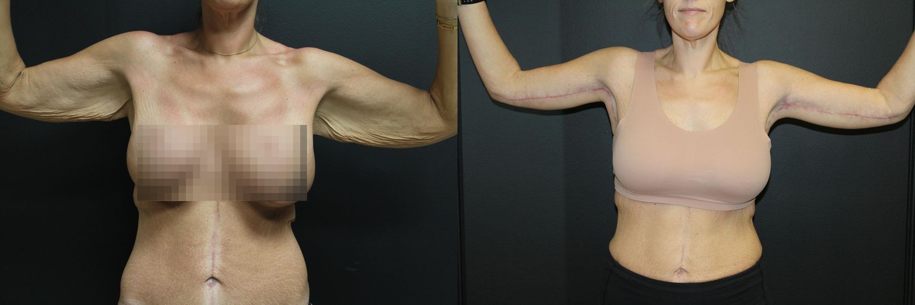 Before and after Arm Lift case 32733