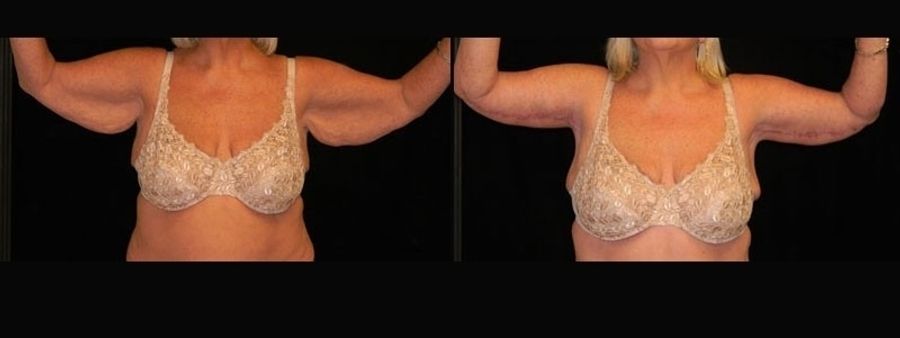 Before and after Arm Lift case 32742