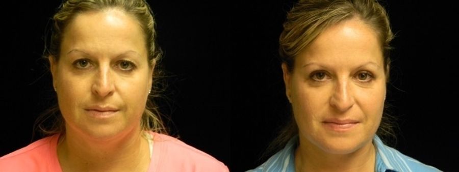 Before and after Blepharoplasty case 32756