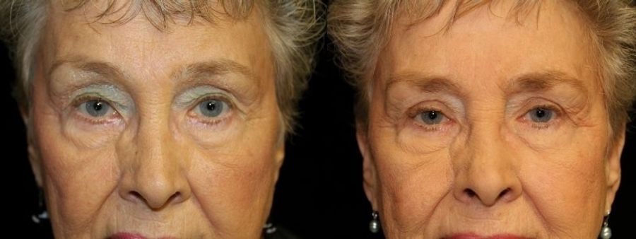 Before and after Blepharoplasty case 32762